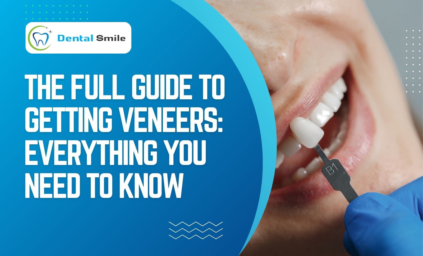 Veneers for Teeth
