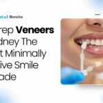 Veneers for Teeth