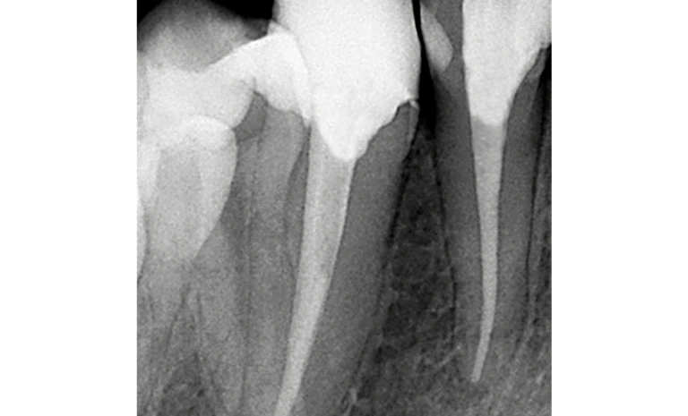endodontist-after