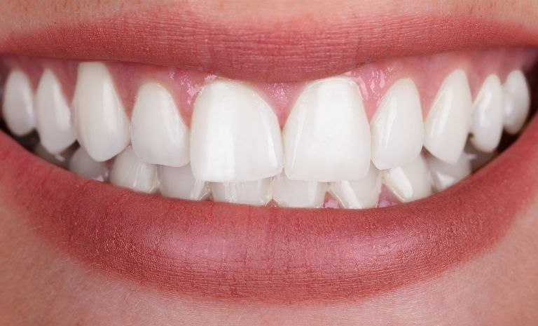 teeth whitening-after