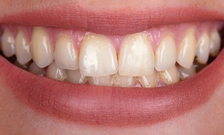 teeth whitening-before