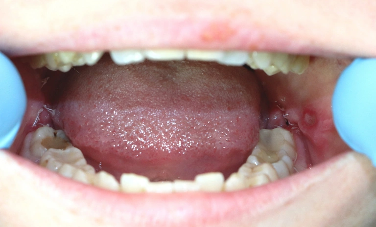 wisdom-teeth-removal-after wisdom-teeth-removal-after