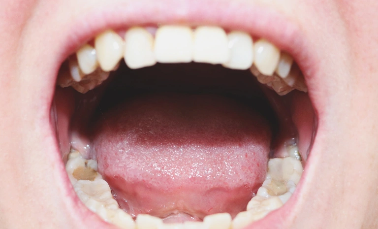 wisdom-teeth-removal-before wisdom-teeth-removal-before