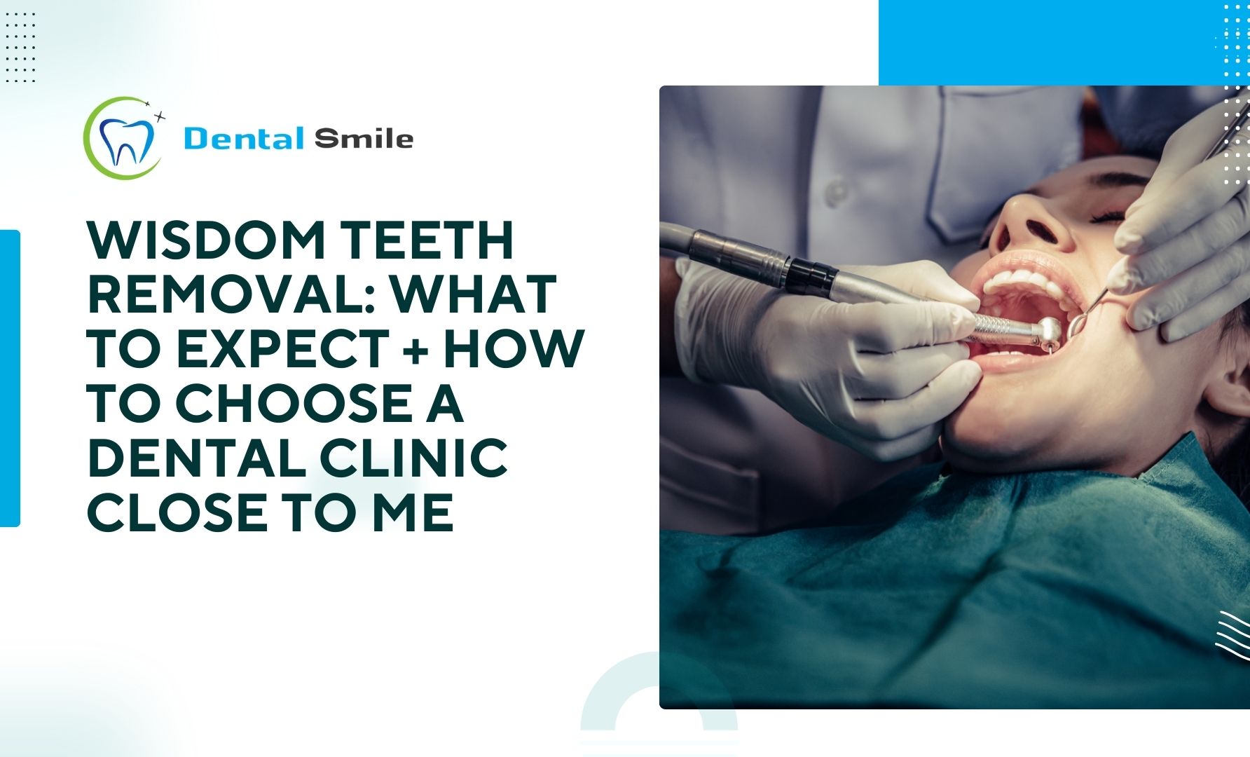 Wisdom Teeth Removal